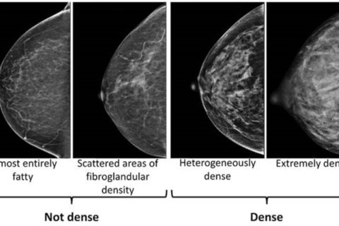 Dense breasts can make it harder to spot cancer on a mammogram