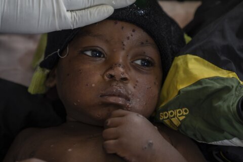 UN authorizes first mpox vaccine for children in an attempt to control Congo outbreak