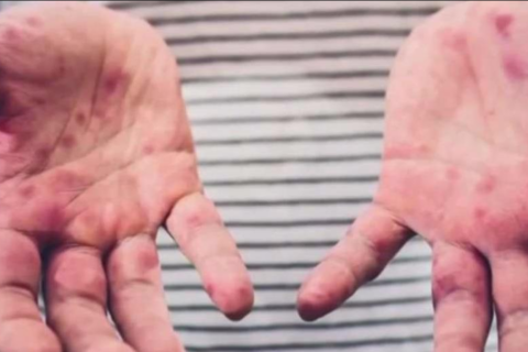 Tercer caso de sarampión en Virginia: aquí los lugares y fechas de posible exposición