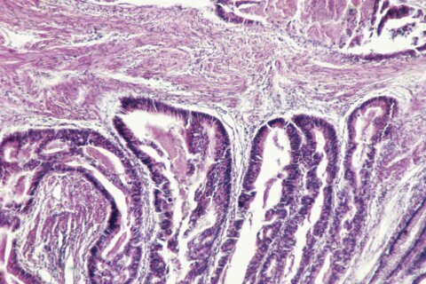 Muertes por cáncer rectal aumentan entre la generación ‘millennial’