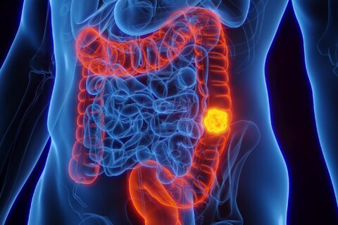 Incluyen un examen de sangre entre opciones para detectar el cáncer colorrectal