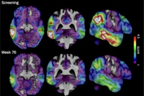 An experimental Alzheimer’s drug shows some promise as researchers hunt new approaches