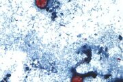 Outbreak of diarrhea-causing parasite grows to more than 1,000 cases