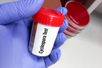Technician holding a specimen container with stool sample for cyclospora test, to diagnosis of cyclosporiasis by examining under a microscope and finding oocysts.