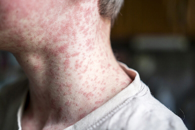 Maryland confirms 2 new measles cases, warns of possible exposures