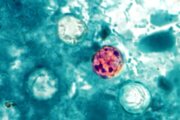 Maryland confirms nearly 150 cases of diarrhea-causing parasite